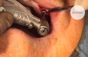 Pose d'implants multiples après sinus lift