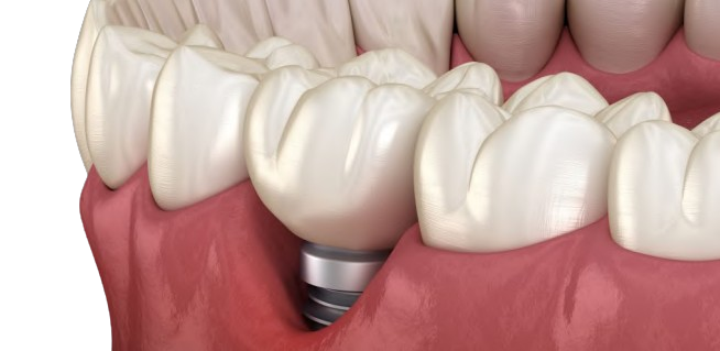 Peri-implantitis: How to Prevent It, How to Manage It?